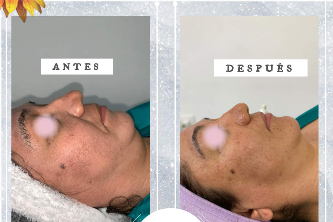 Mesoterapia Facial